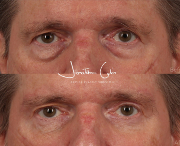 Direct Browlift, Lower Blepharoplasty and Fat Grafting