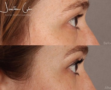 Lower Blepharoplasty with Midcheek Fat Grafting
