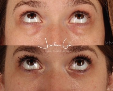 Lower Blepharoplasty with Midcheek Fat Grafting