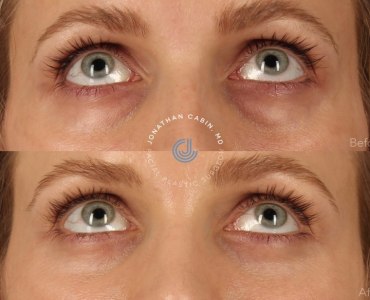 Lower Blepharoplasty, Fat Grafting, CO2 Laser Resurfacing