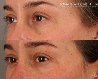 Lower Blepharoplasty Fat and Laser