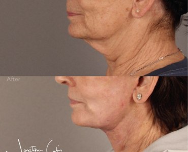 Revision facelift and deep necklift