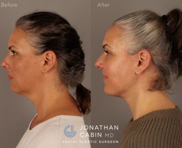 Deep Plane Facelift and Neck Lift