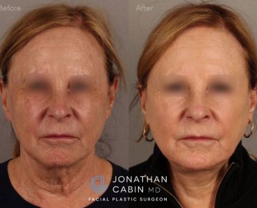 Revision Deep Plane Facelift and Neck Lift with Lower Blepharoplasty, Fat Grafting and Fractionated CO2 Laser Resurfacing