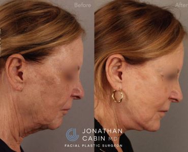 Revision Deep Plane Facelift and Neck Lift with Lower Blepharoplasty, Fat Grafting and Fractionated CO2 Laser Resurfacing