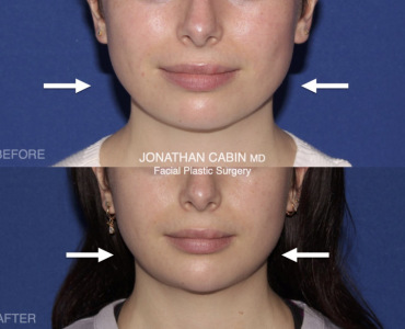 Non-Surgical Facial Slimming
