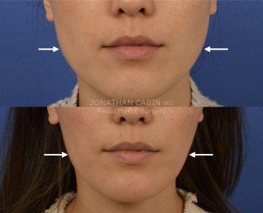 Non-Surgical Facial Slimming