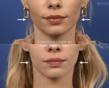 Non-Surgical Facial Slimming