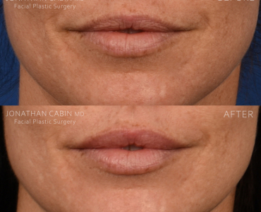 Lip Filler