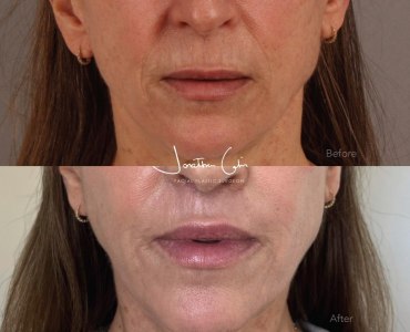 Lip Lift with CO2 Laser Resurfacing