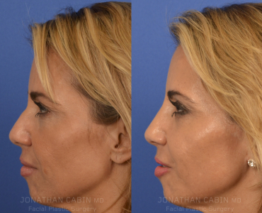 Non-Surgical Rhinoplasty
