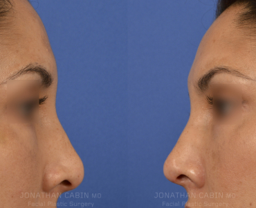 Non-Surgical Rhinoplasty