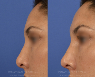 Non-Surgical Rhinoplasty