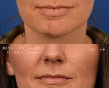 Non-Surgical Chin Contouring (Patient with genetic chin deformity) and Lip Piercing Closure