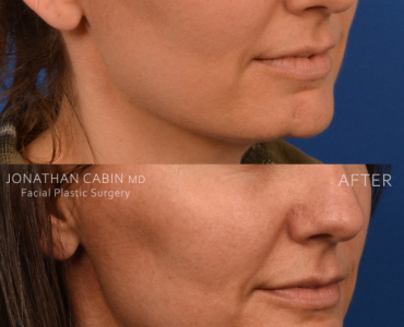 Non-Surgical Chin Contouring (Patient with genetic chin deformity) and Lip Piercing Closure