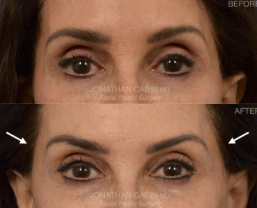 Volume Restoration to Temples with Sculptra