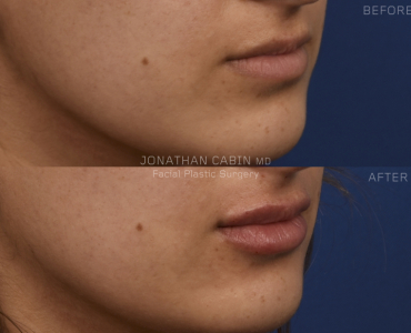 Lip Filler