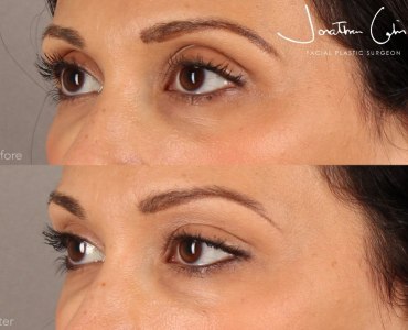 Upper Eyelid Contouring