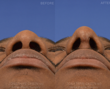 Primary Rhinoplasty