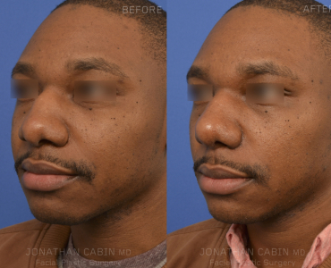 Primary Rhinoplasty