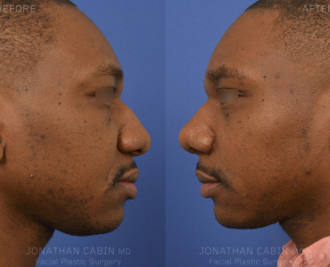 Primary Rhinoplasty
