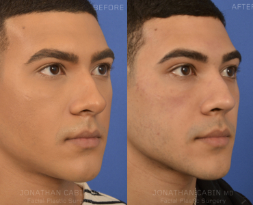 Primary Finesse Rhinoplasty