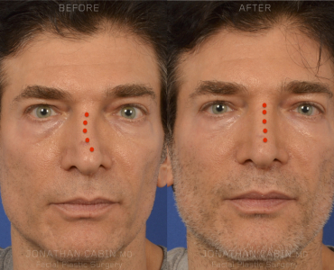 Closed Rhinoplasty