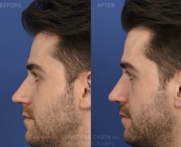 Primary Finesse Rhinoplasty