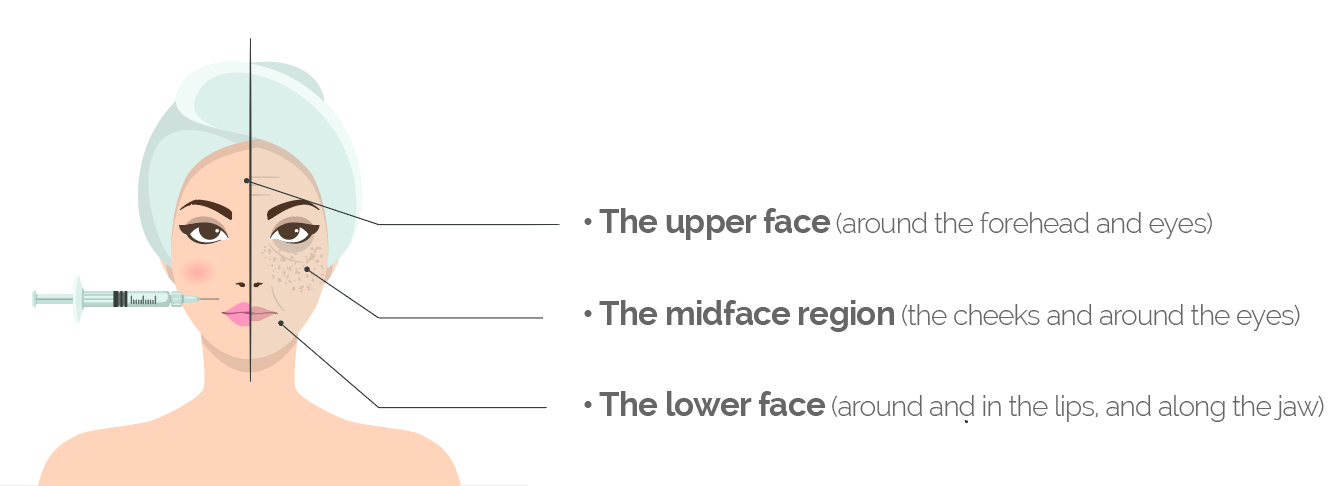 face regions for the filler injection