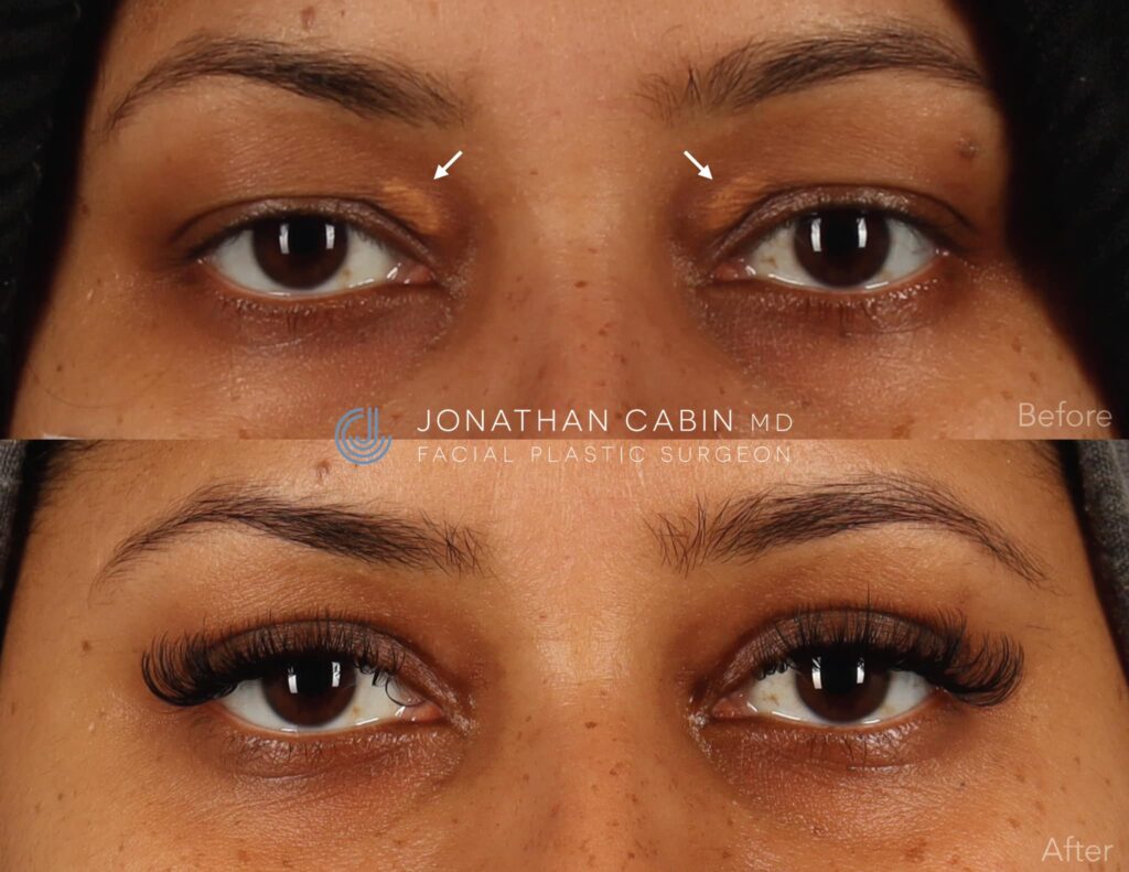 Scar Treatment | Dr. Jonathan Cabin | Non-Surgical Scar Treatment