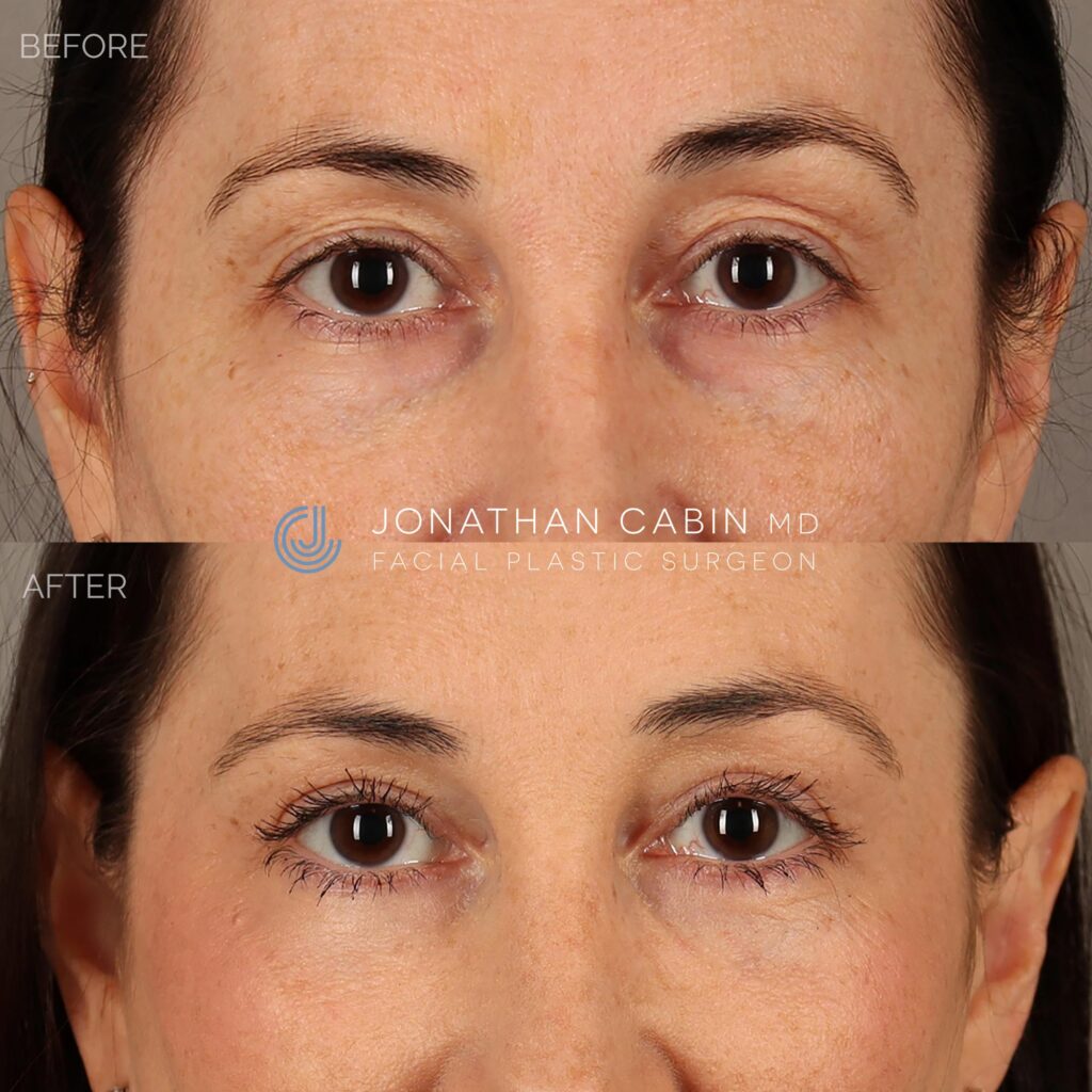 54 - LM - Upper Blepharoplasty, Lower Blepharoplasty, Fat Grafting, CO2 Laser around Eyes - UPPER FACE ONLY_7