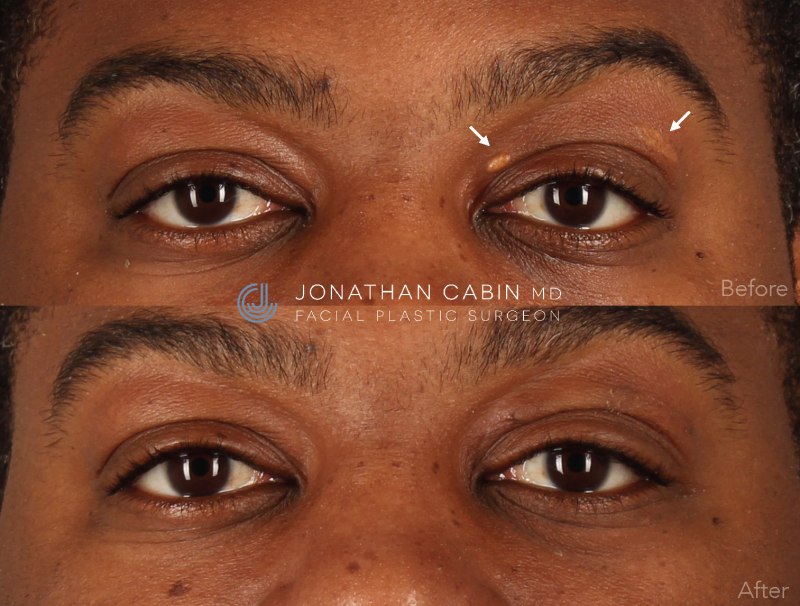 Jonathan Cabin Before and After