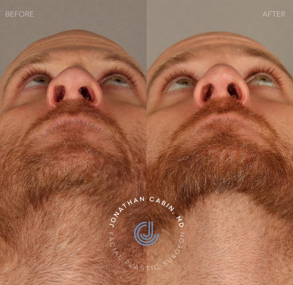 Rhinoplasty Washington DC