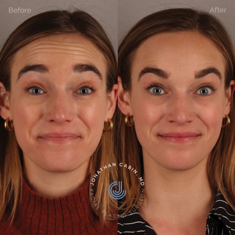 The Difference Between Botox and Filler