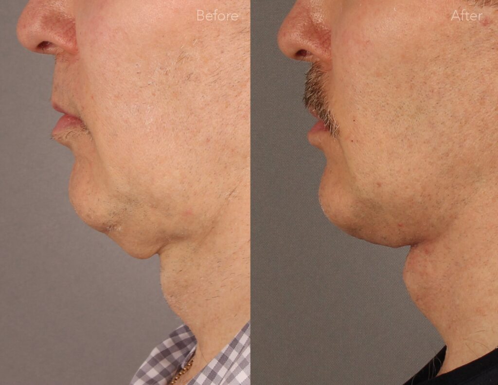What to Know Before Getting a Neck Lift 