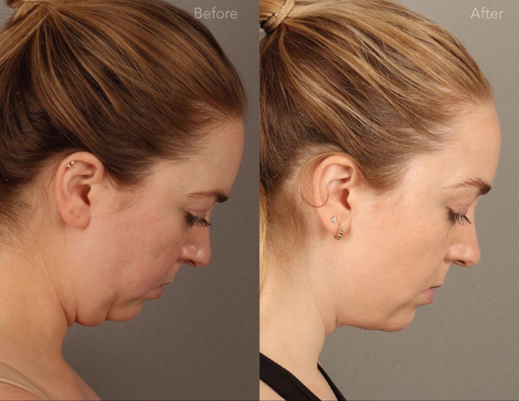 What to Know Before Getting a Neck Lift 