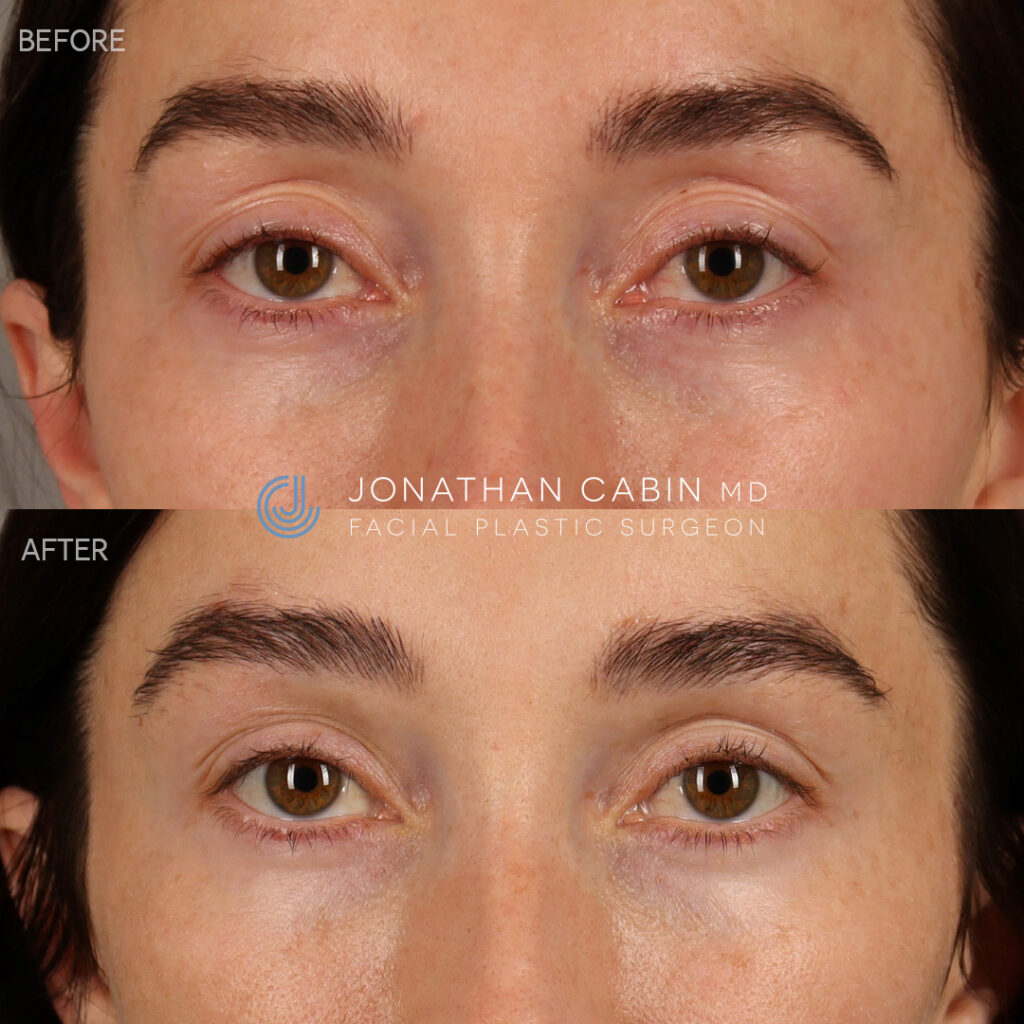 2023-10-03_Jonathan Cabin_BA Edits_Upper Eyelid and Temple Filler - 2 Weeks - Upper Face_Front 1_CG