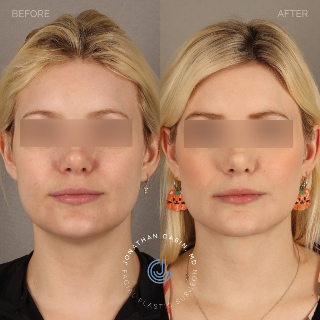 2024-03-18_Jonathan Cabin_73 - Deep Neck Lift Facial Fat Grafting Buccal Fat Reduction - Full Face with Blocked Eyes_Front_1_GM
