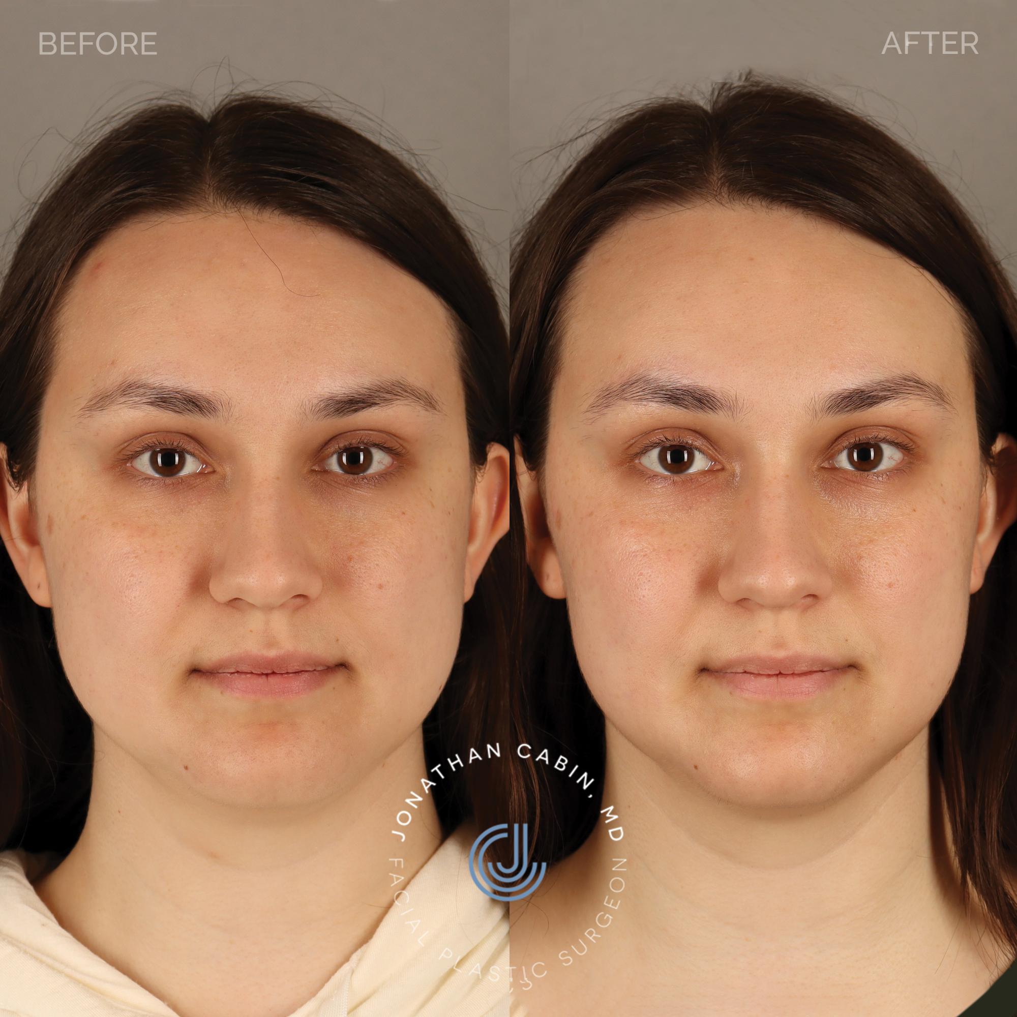 Masseter (TMJ) Botox / Non-Surgical Facial Slimming - Dr. Jonathan Cabin