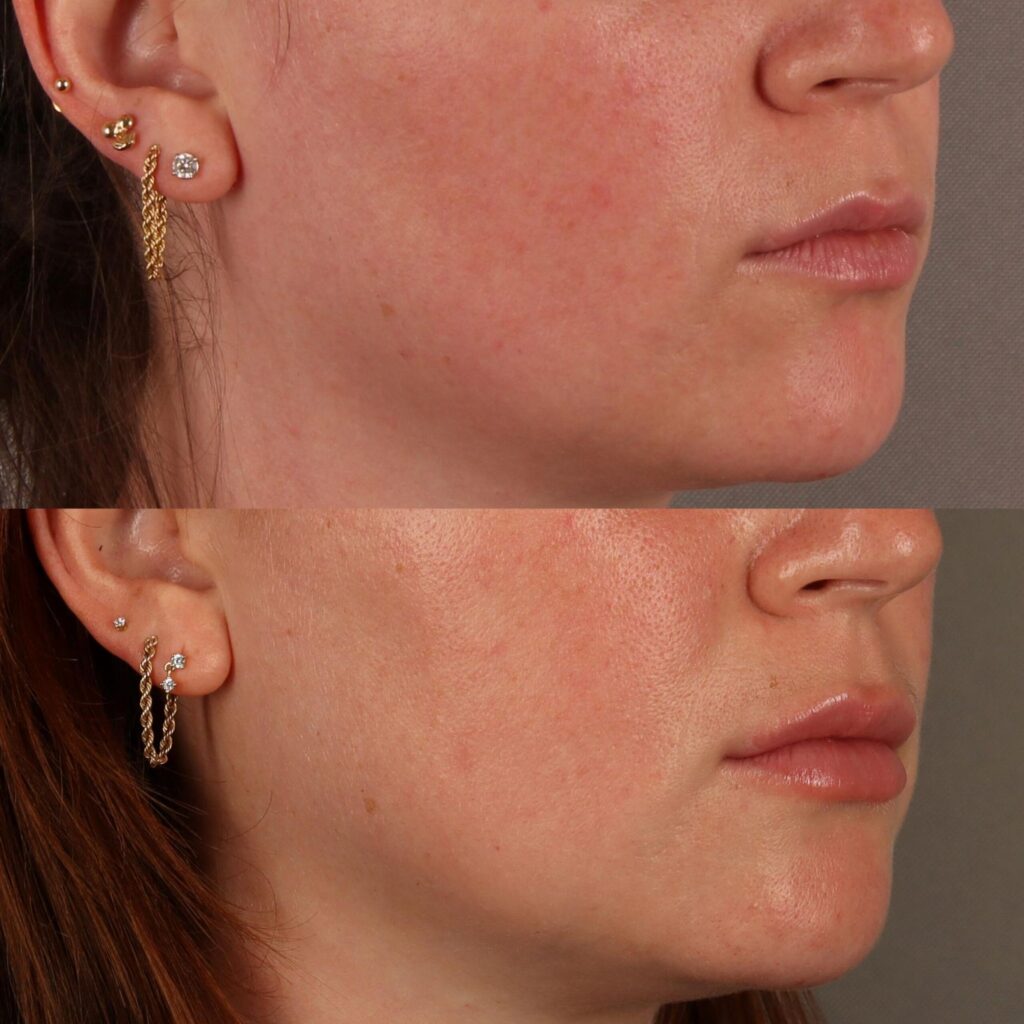 Lip Lifts and Lip Augmentation Options at CabinMD