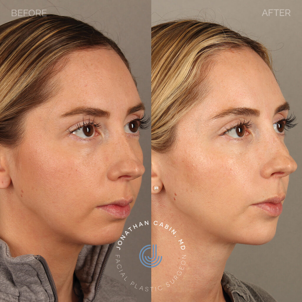 How Buccal Fat Removal Can Give You a Sculpted Look