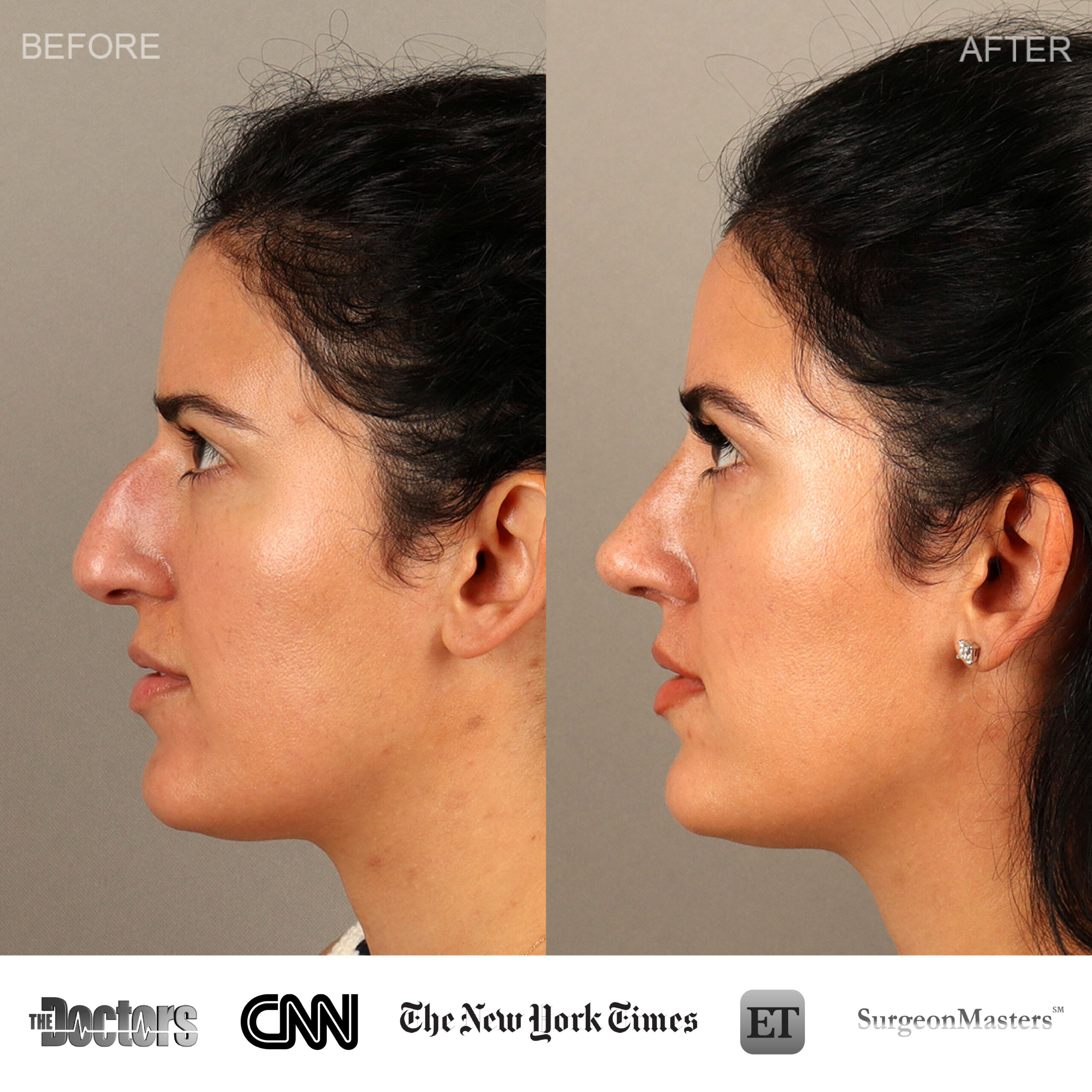 Before and after profile images of a female patient showcasing rhinoplasty results, highlighting improved nasal structure and facial harmony, relevant to Dr. Jonathan Cabin's expertise in rhinoplasty and plastic surgery in Washington DC.
