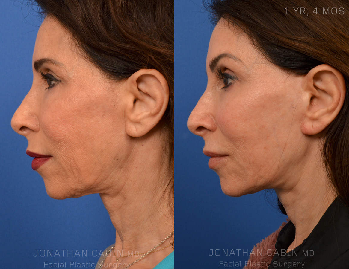 Before and after images of a female patient showcasing results of a deep plane facelift, illustrating improved jawline and cheek contours, emphasizing natural rejuvenation.