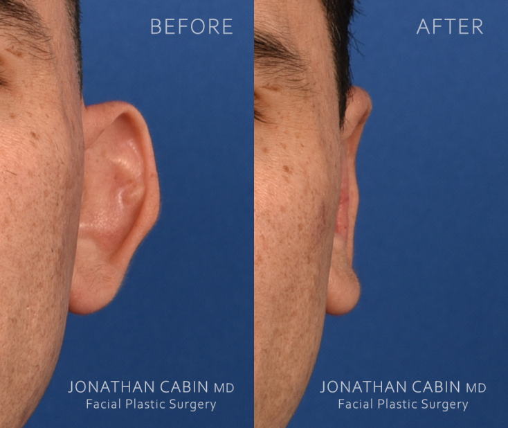 1-Before-after-Front-close