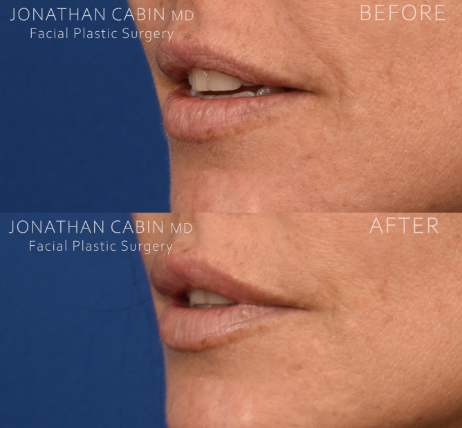 3-Before-after-L-Oblique-lips