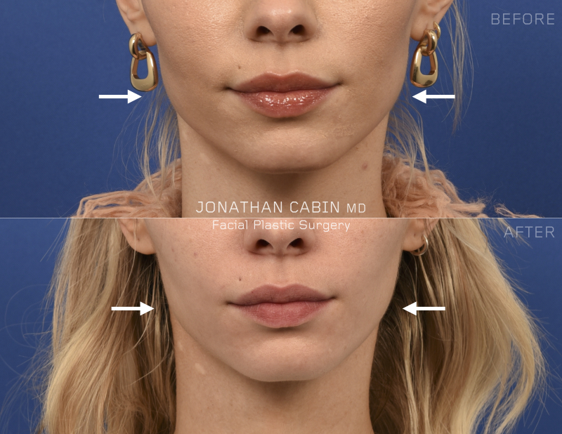 Botox-with-arrows