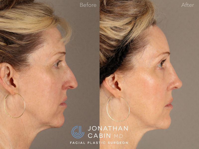 ERHI0002-Rhinoplasty_Page_2.jpg