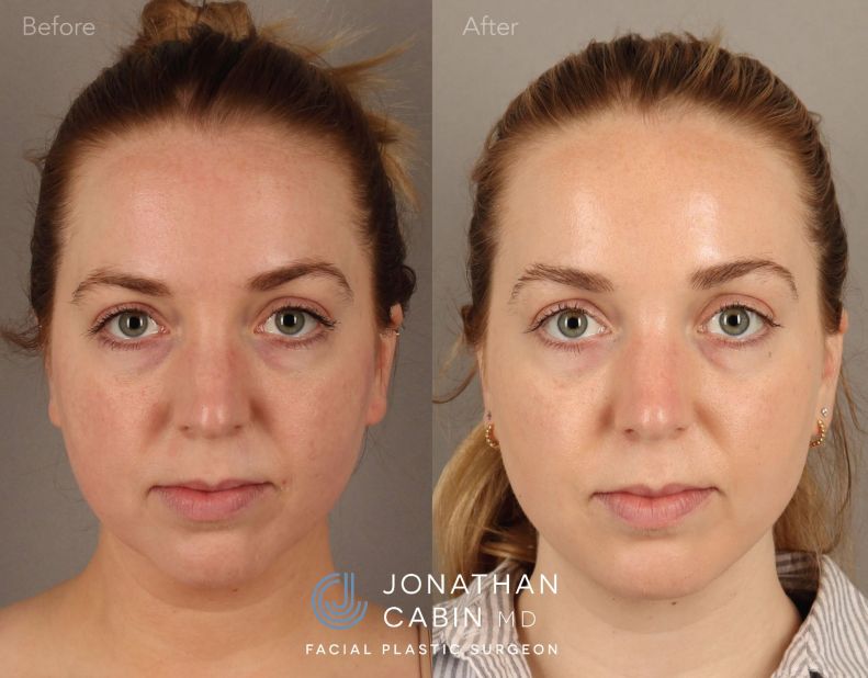 KAMC0021-Deep-Neck-Buccal-Fat-Fat-Grafting_Page_1