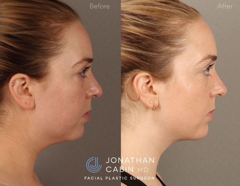 KAMC0021-Deep-Neck-Buccal-Fat-Fat-Grafting_Page_6