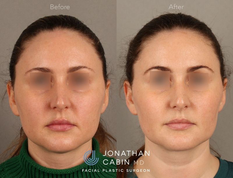 KEHA0219-Lipo-FaceTite-Buccal-Fat_Page_3